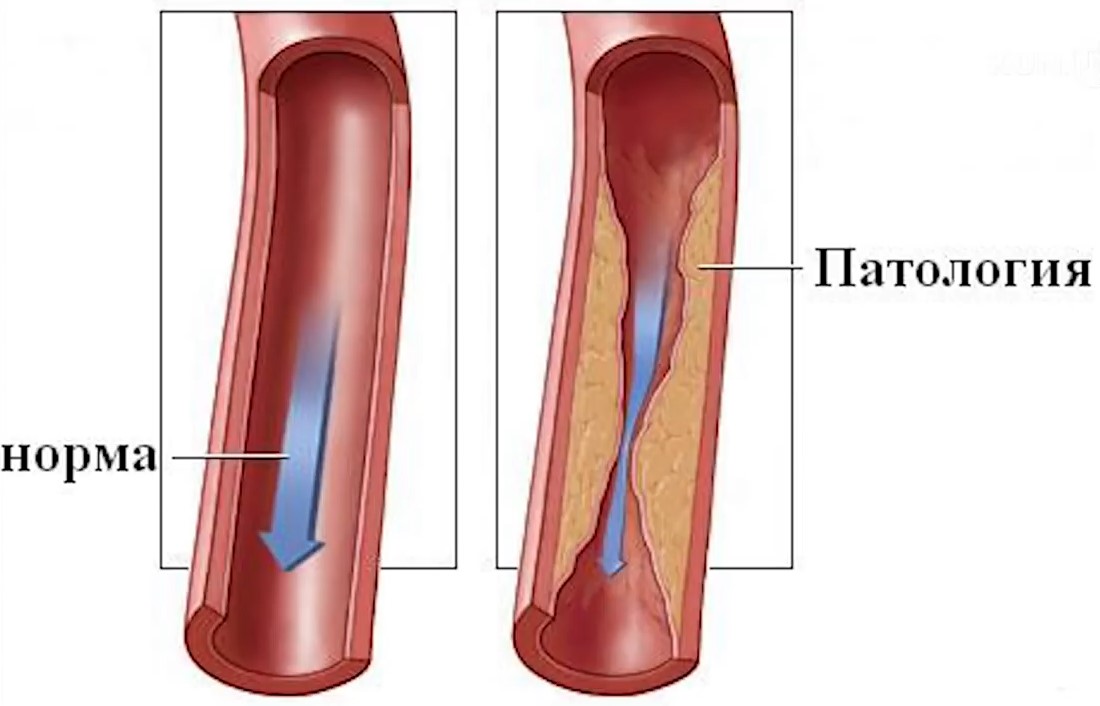 Нормальный сосуд. Стеноз кровеносных сосудов. Ангиоспазм бедренной артерии.