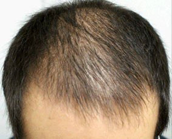 Выпадение волос у мужчин лечение. Андрогенная алопеция миноксидил. Миноксидил лобные залысины.