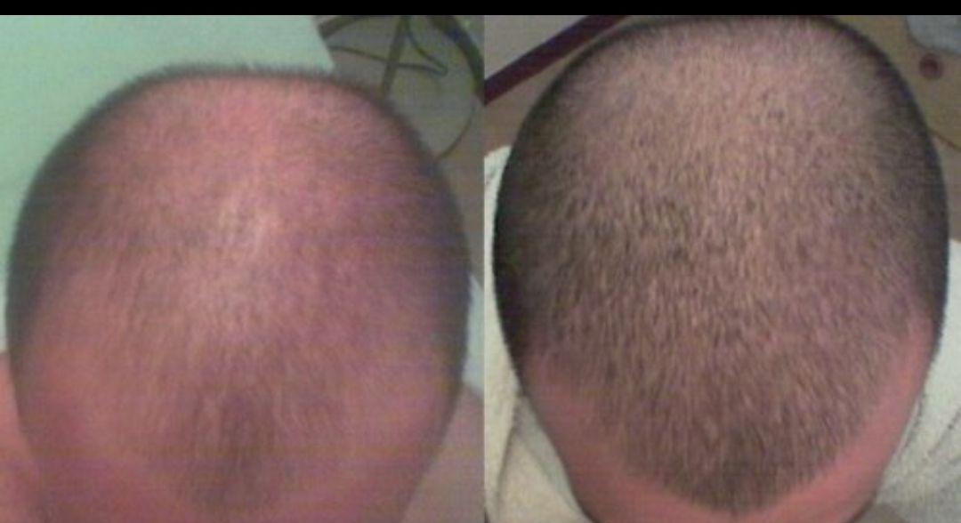 Пересадка волос выпадают волосы. Миноксидил лобные залысины. Андрогенная алопеция миноксидил. Никотиновая кислота облысение у мужчин. Голова после пересадки волос.