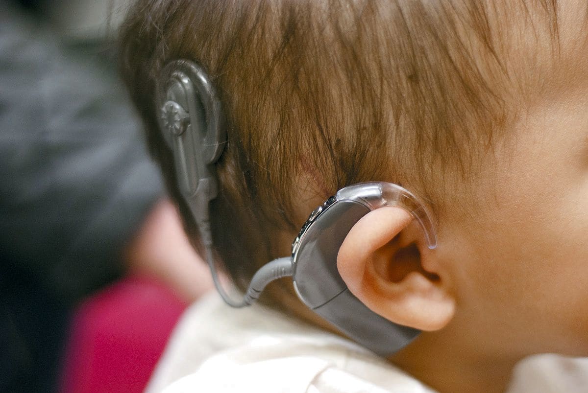 Слуховой имплант. Кохлеарная имплантация Cochlear. Кохлеарный имплант Кохлер. Слуховой аппарат кохлеарный имплант. Аппарат для глухих кохлеарная имплантация.