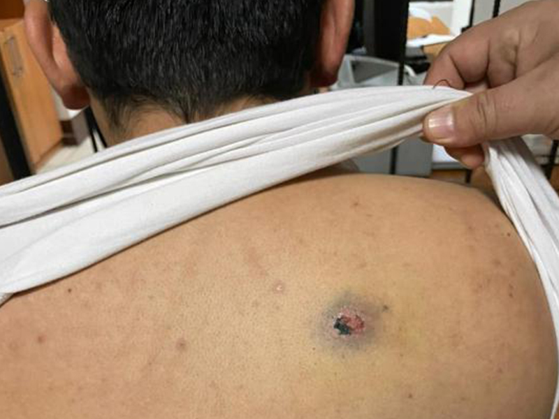 Пулевое ранение против осколочного | Пикабу